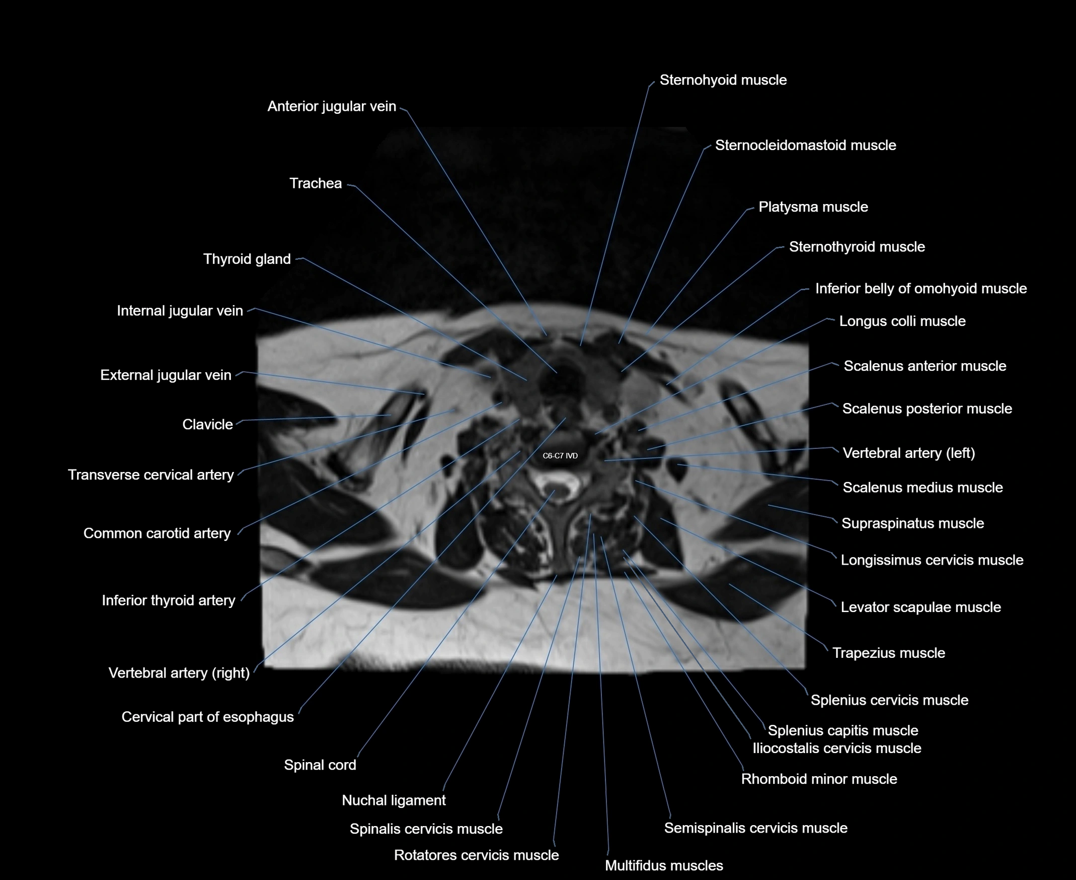 MRI Neck 3D labelled cross section anatomy axial 3t image-00001-00073.webp